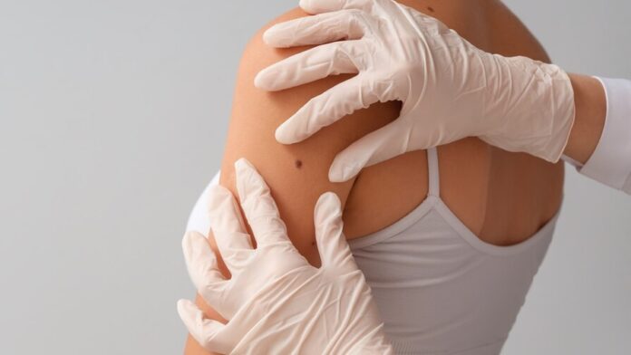 Dermatologist,Examining,Young,Woman's,Mole,On,Light,Background,,Closeup